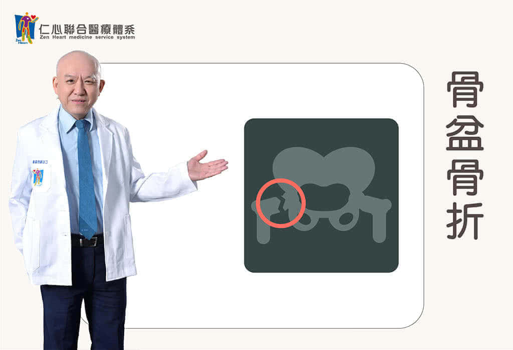 骨盘骨折